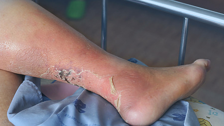 Photographies : Ulcère de la jambe