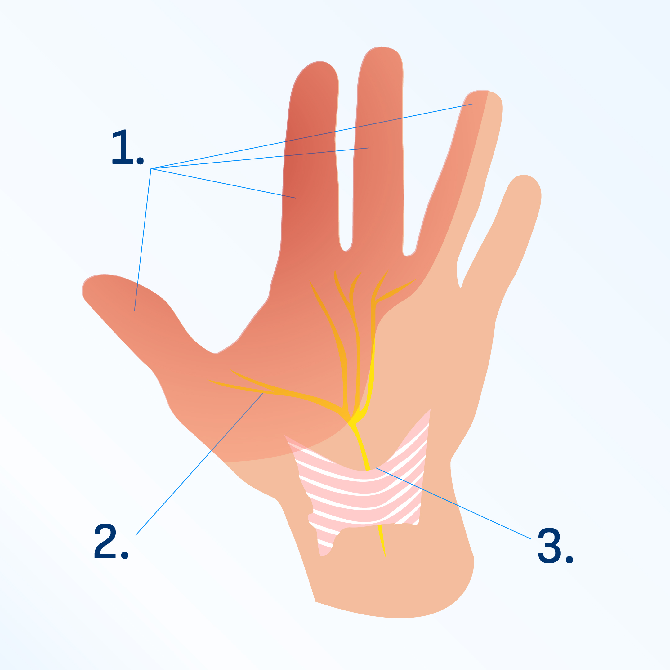 Photo: biomag.fr 1. Nerf comprimé et partie de la main insensible en gris 2. Nerf médian 3. Ligament carpien transverse