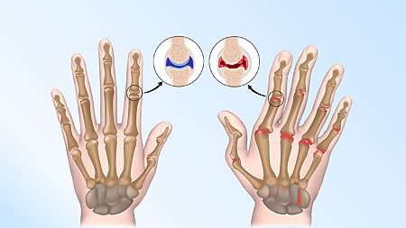 La polyarthrite rhumatoïde affecte le plus souvent les articulations des mains.